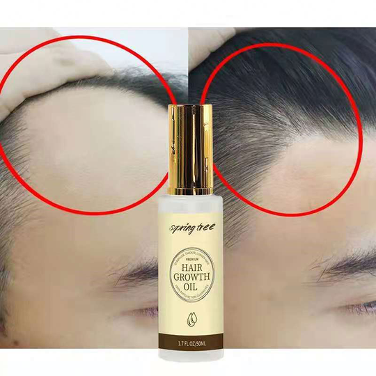 Private Label Hair Regrowth Hair Loss Treatment Oil Hair Growth Serum Natural Ginger Aceites Esenciales Soin Cheveux For Women